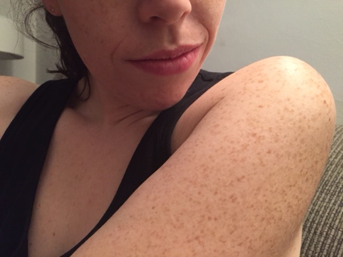 "I have red bumps on my upper arms, help!" Hannah Sowd Skin Care