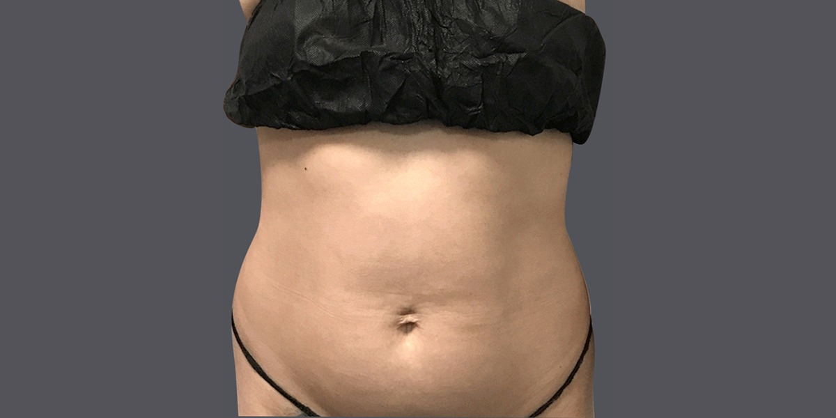 Vaser Lipo on Stomach Before & After Hansplace
