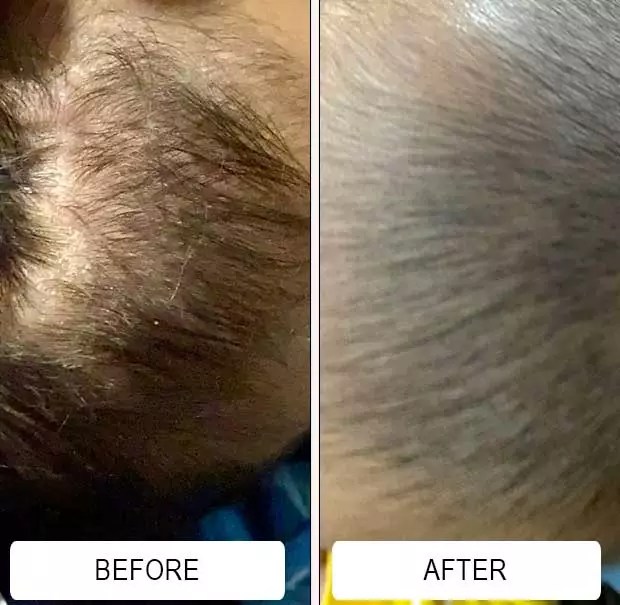 Best Cradle Cap Shampoo for Babies Happy Cappy