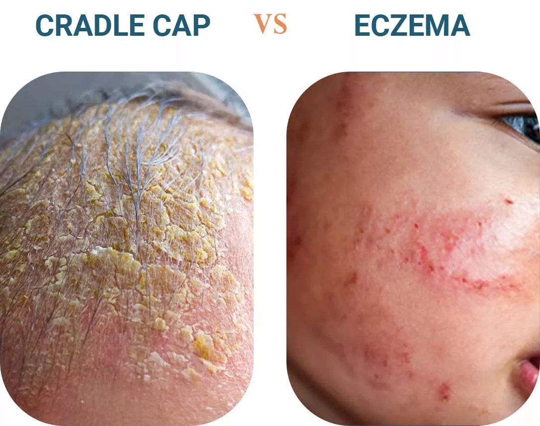 Costra láctea vs. eczema ¿Cuál es la diferencia?