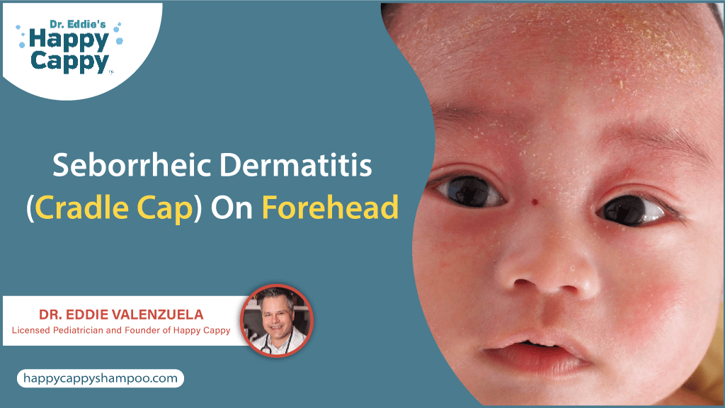 Seborrheic Dermatitis (Cradle Cap) on Forehead Happy Cappy