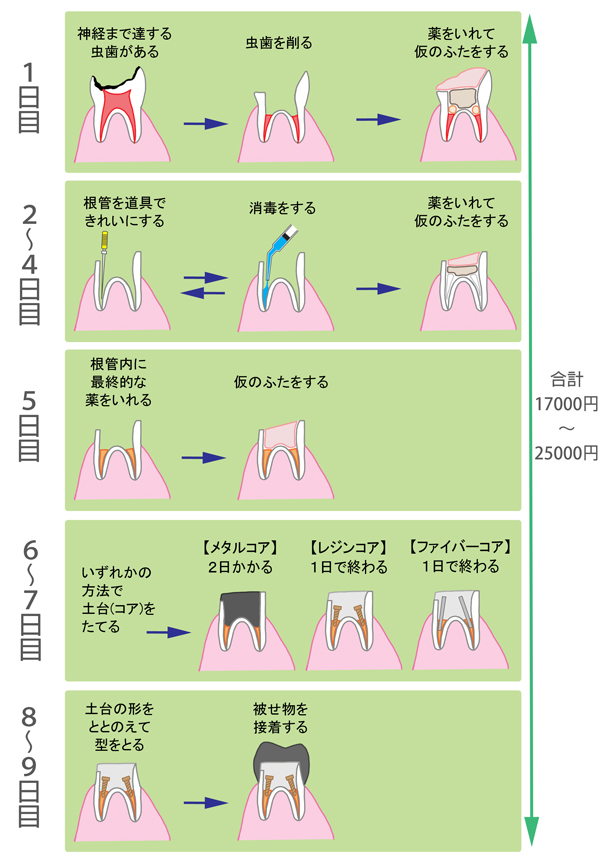 List Of 虫歯 治療 費用 保険 Article