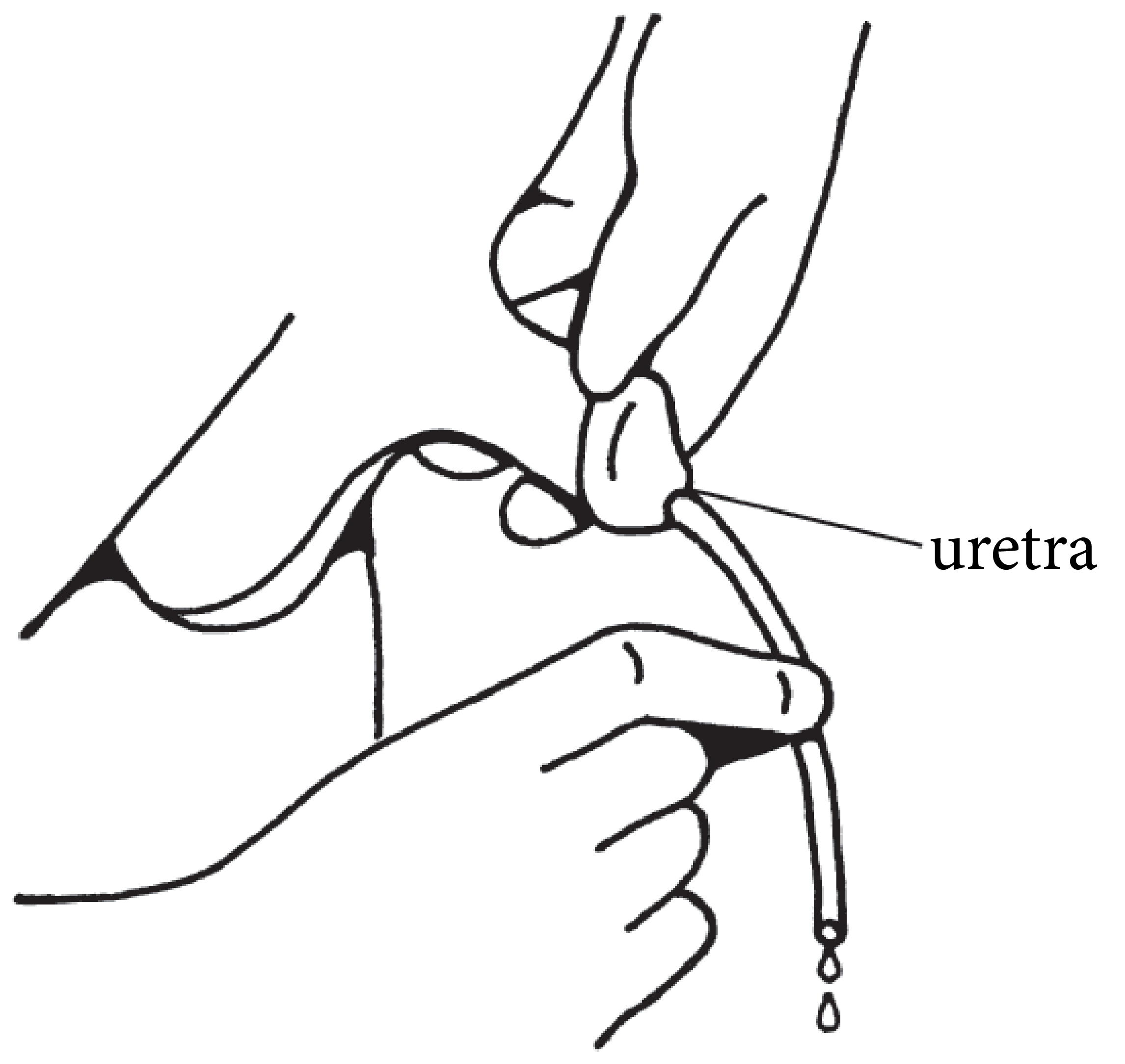 Clean Intermittent Catheterization for Boys Gig Harbor, WA Harbor