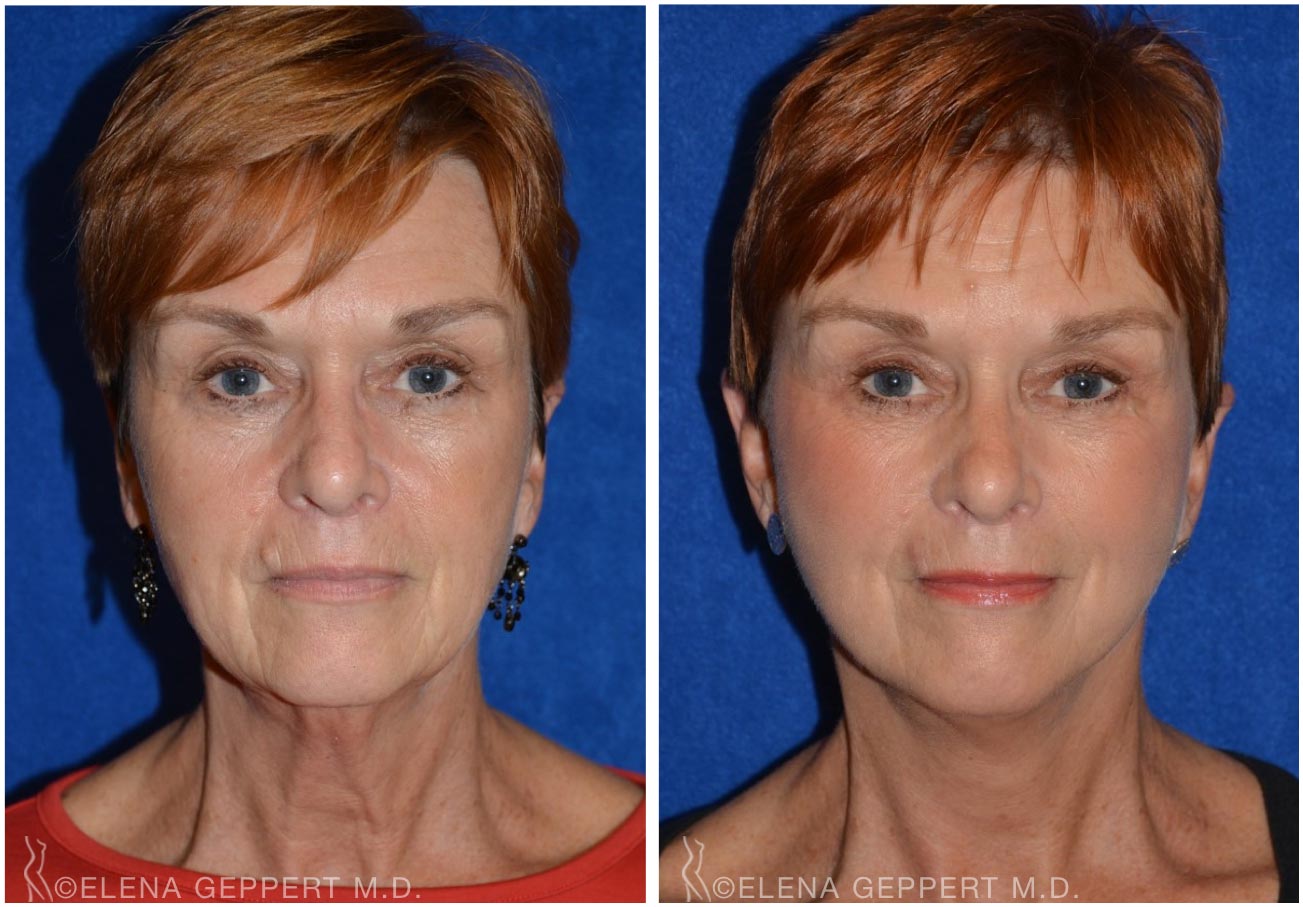 FaceLift Harbour Plastic Surgery Recapture Beauty