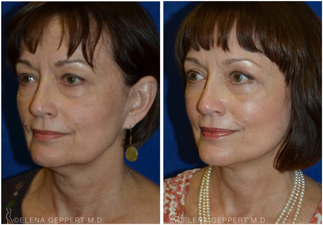 FaceLift Harbour Plastic Surgery Recapture Beauty