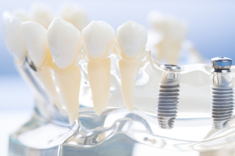 Are Dental Implants Safe? What You Should Know Before the Procedure