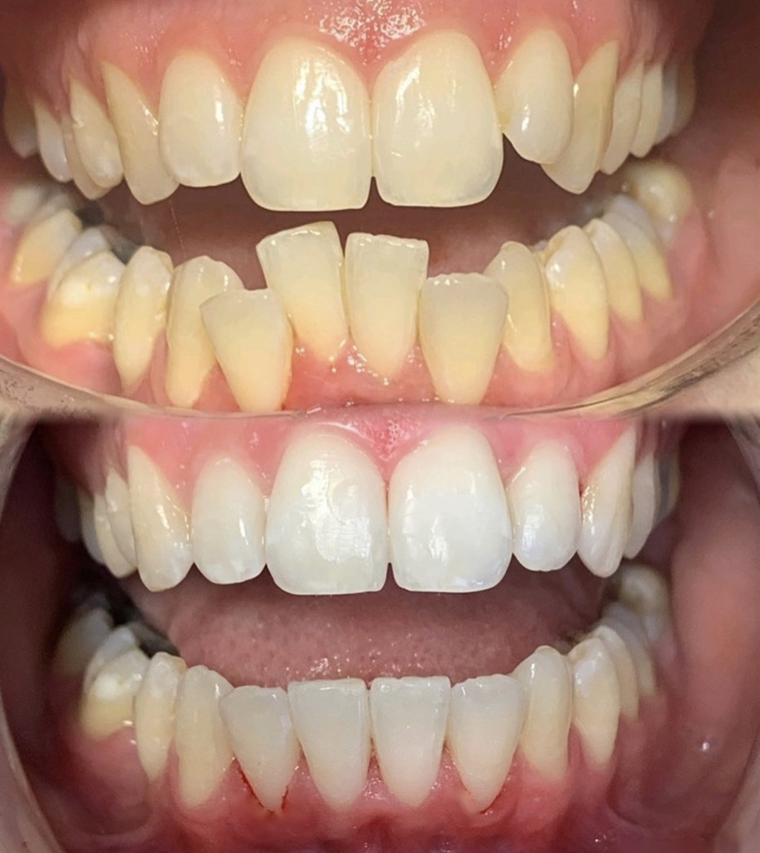 Before & After Transformations Harewood Dental Practice in Virginia