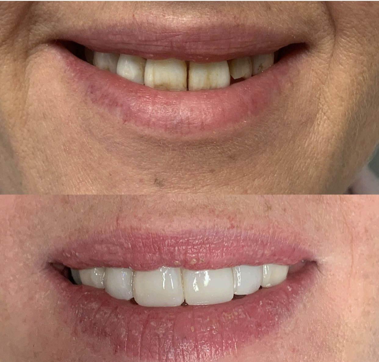 Before & After Transformations Harewood Dental Practice in Virginia