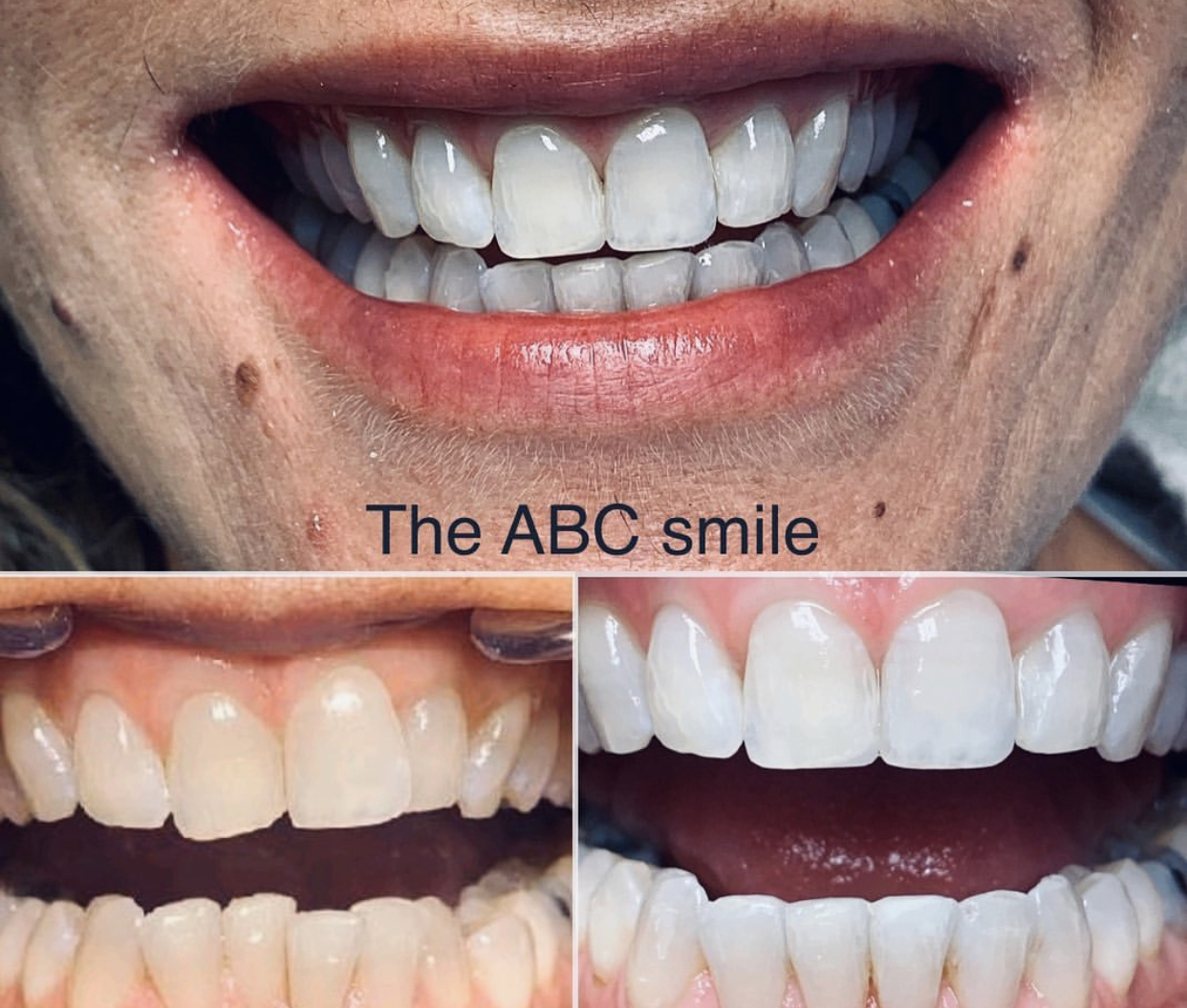 Before & After Transformations Harewood Dental Practice in Virginia