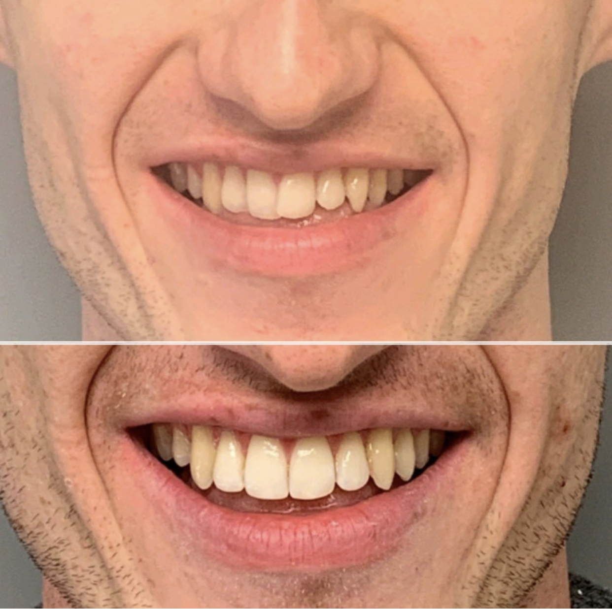 Before & After Transformations Harewood Dental Practice in Virginia