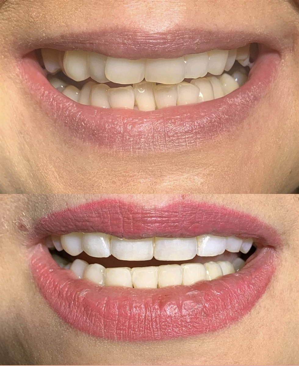 Before & After Transformations Harewood Dental Practice in Virginia