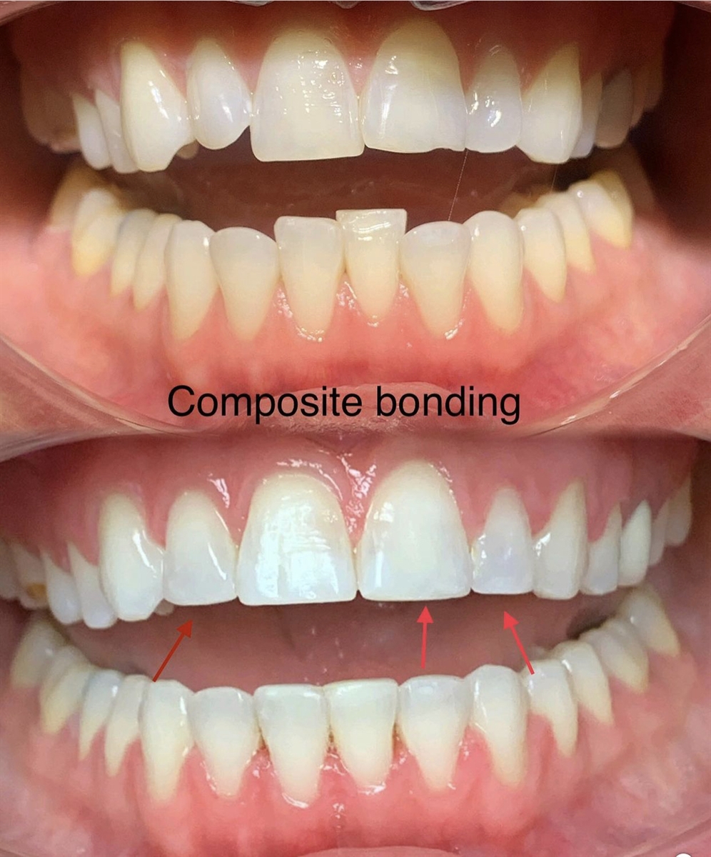 Before & After Transformations Harewood Dental Practice in Virginia