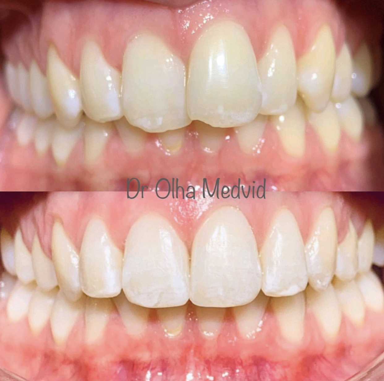 Before & After Transformations Harewood Dental Practice in Virginia