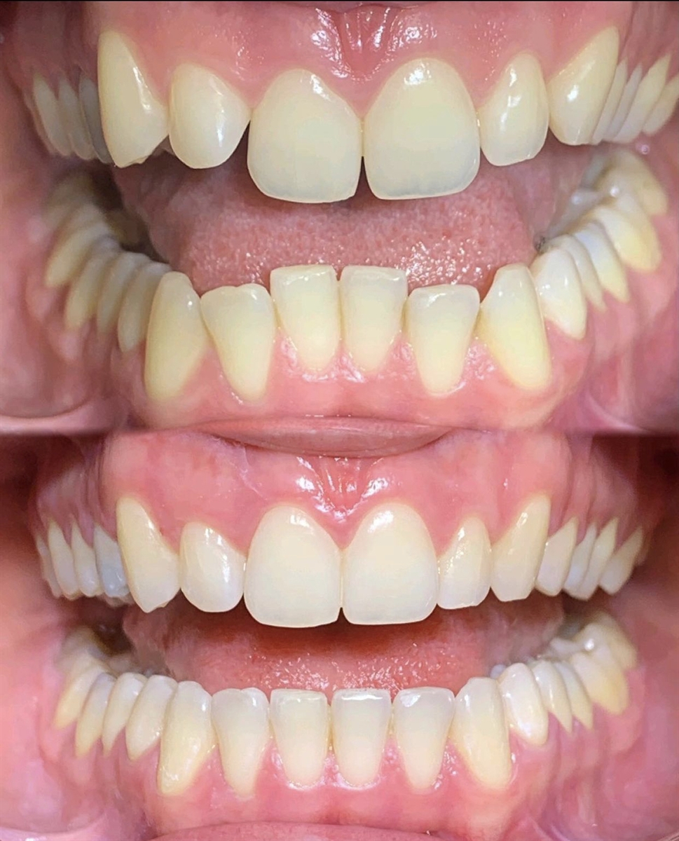 Before & After Transformations Harewood Dental Practice in Virginia