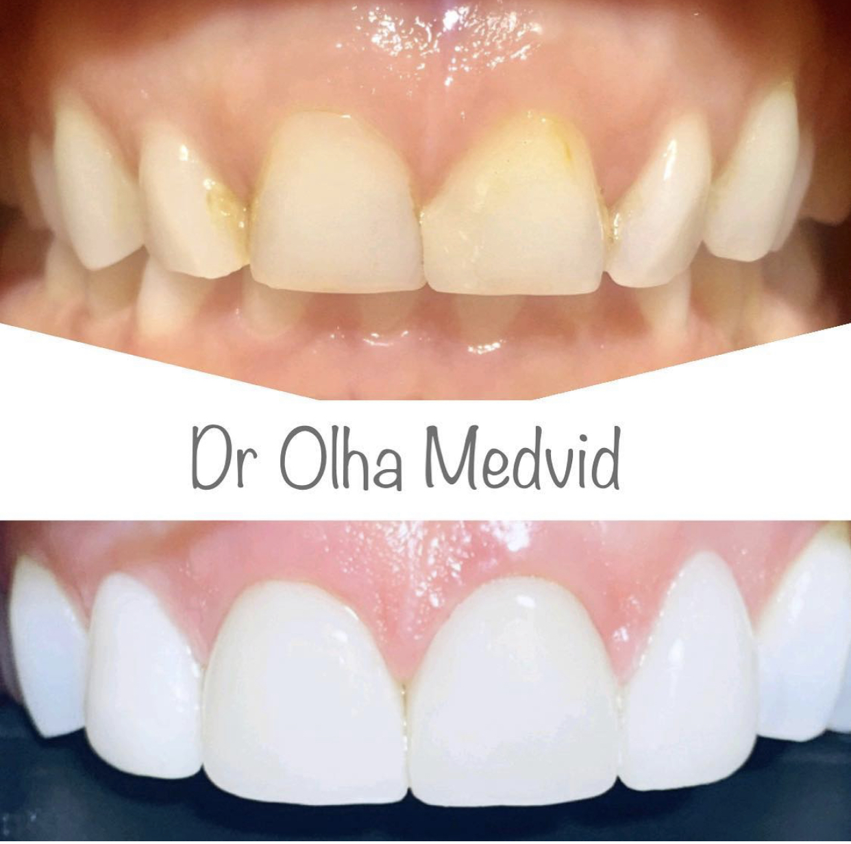 Before & After Transformations Harewood Dental Practice in Virginia