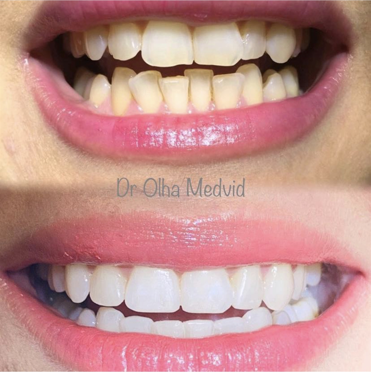 Before & After Transformations Harewood Dental Practice in Virginia