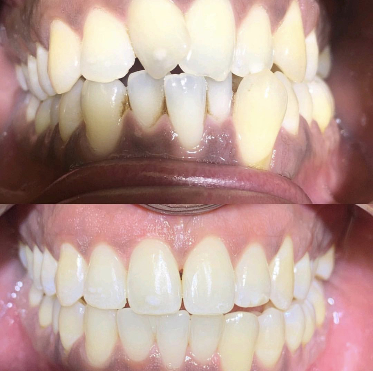 Before & After Transformations Harewood Dental Practice in Virginia