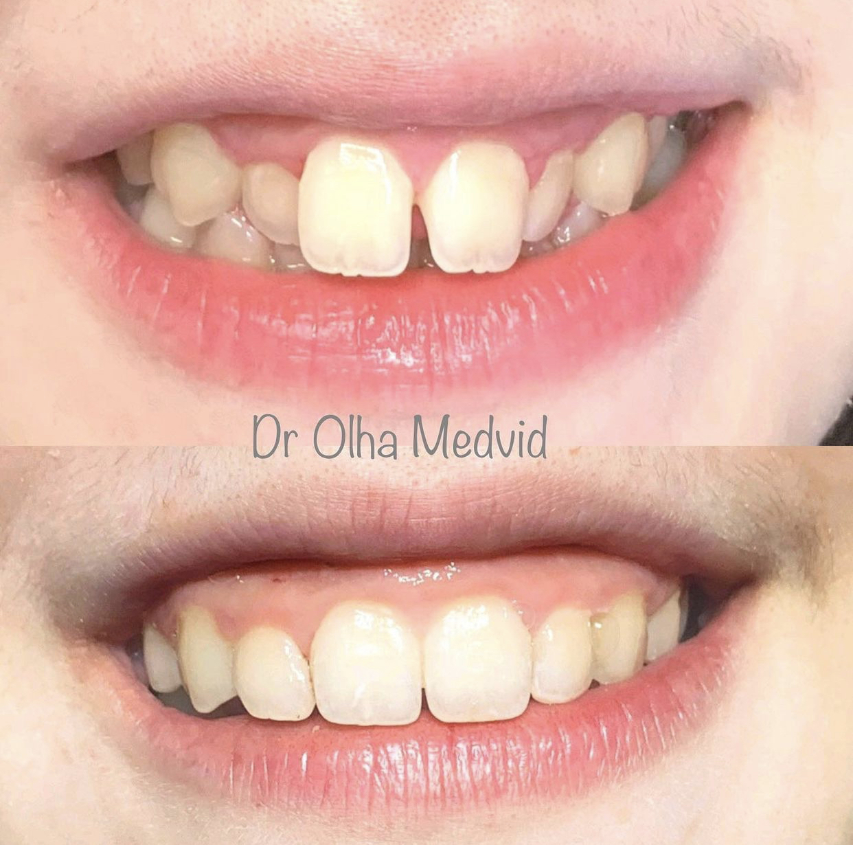 Before & After Transformations Harewood Dental Practice in Virginia