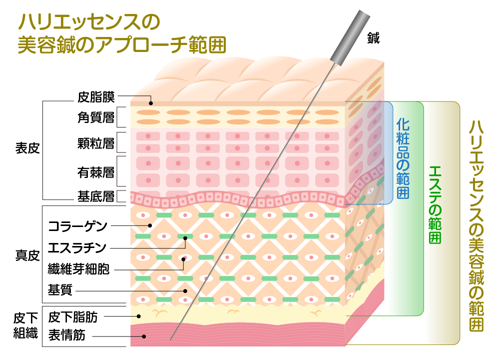 ダーマペンと美容鍼 それぞれのメリット・デメリット 西宮北口の鍼灸院・美容鍼｜ハリエッセンス(女性専門)