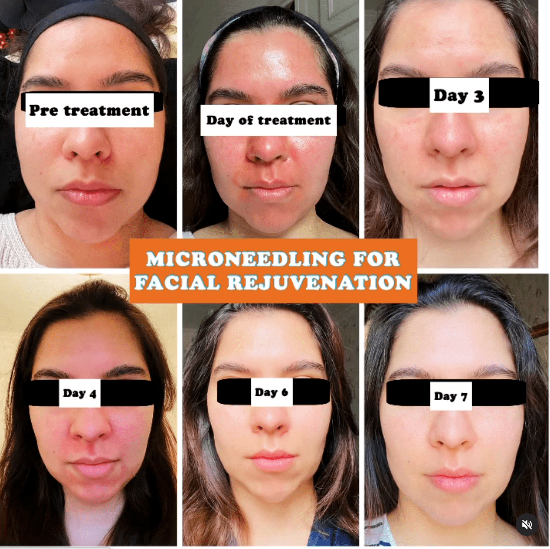 Microneedling Harley Clinic