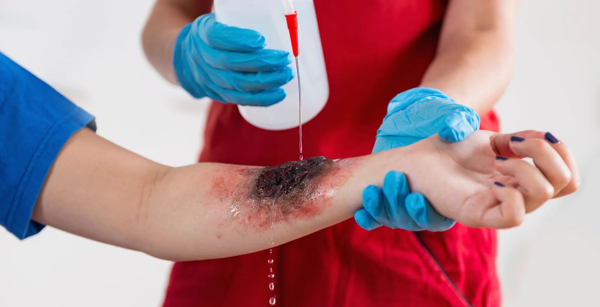 How to Prevent Burn Blisters and Provide First Aid HarmLess New Zealand