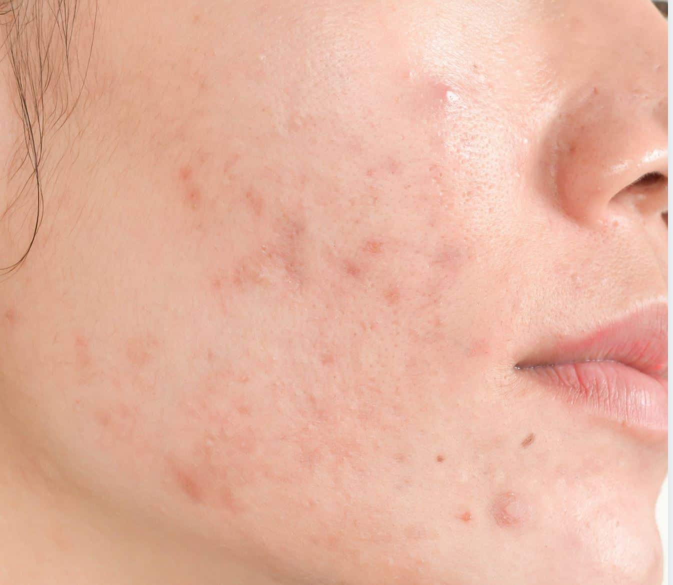 Acne Scar Treatment Singapore Harmony Aesthetics Clinic (Novena)
