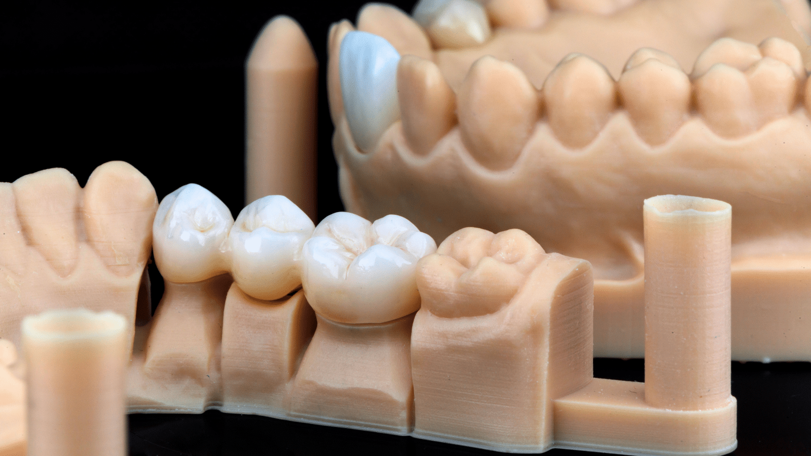 The Longevity of Dental Crowns How Long Should They Last? Harmony