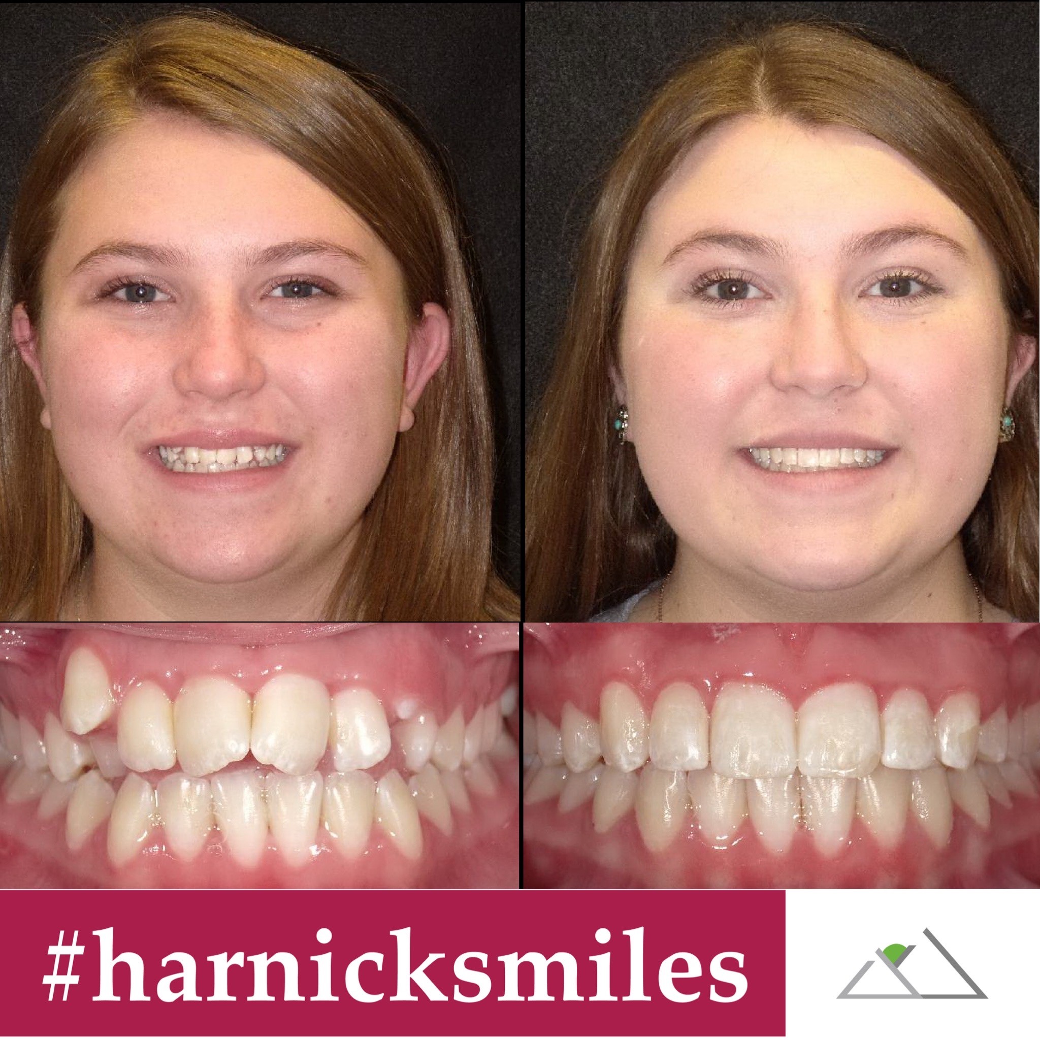 Harnick Orthodontics Albuquerque Braces & Invisalign Results