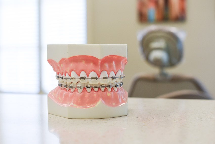 Braces Jay Harris Orthodontics iTero® Element™ Intraoral Scanner