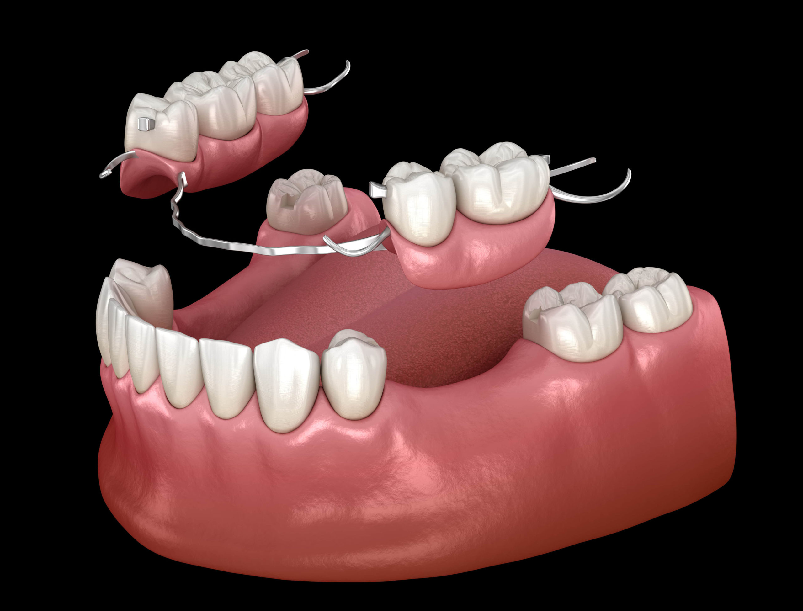 Partial Dentures / Implant Partial Dentures Hasenfus Family Dental