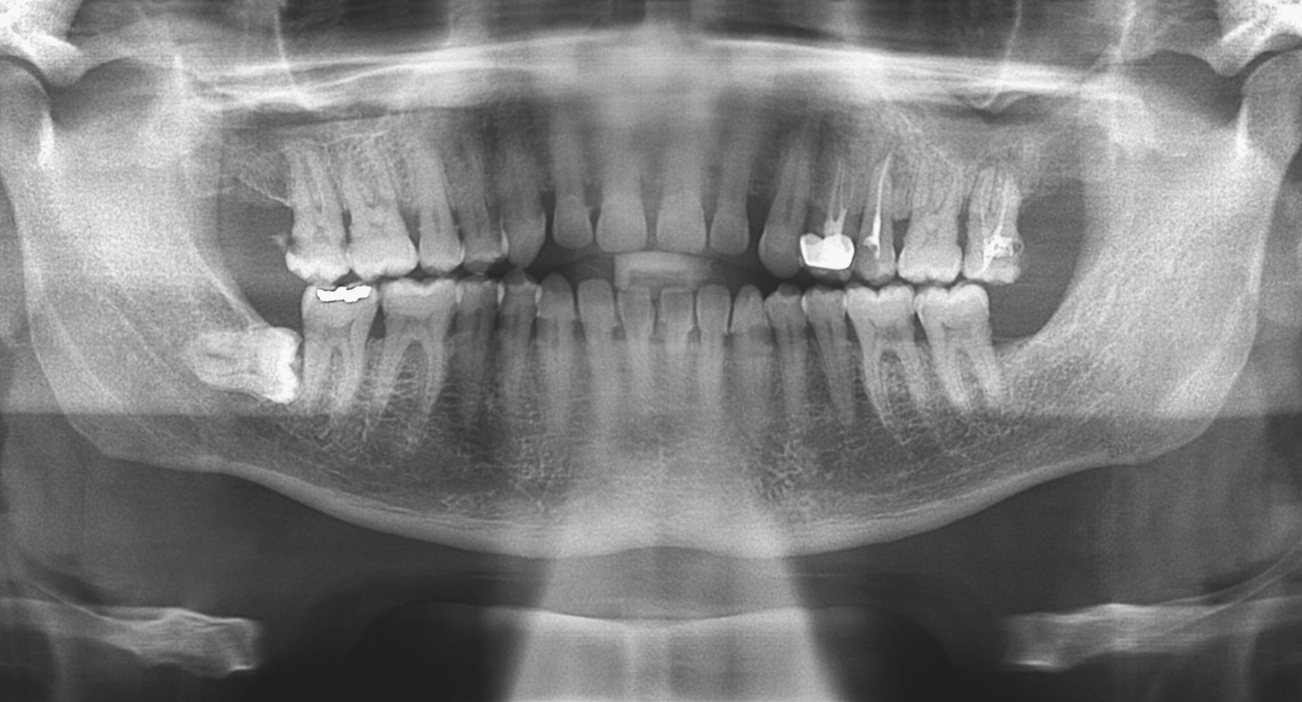 Dental XRays / Radiographs Hasenfus Family Dental