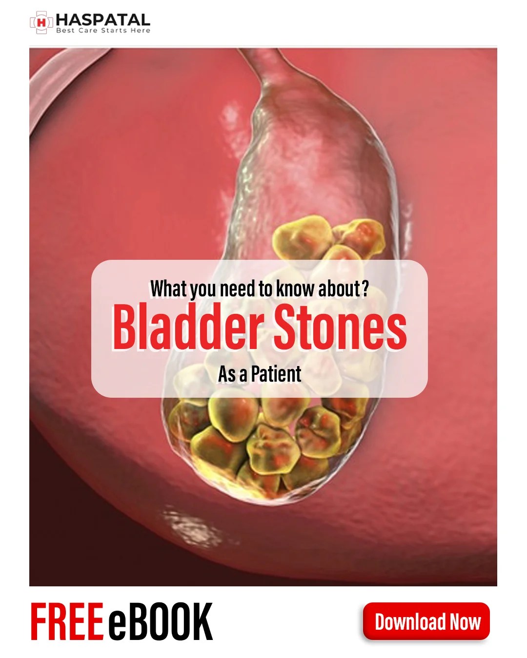 Bladder Stones and Symptoms Haspatal online consultation app