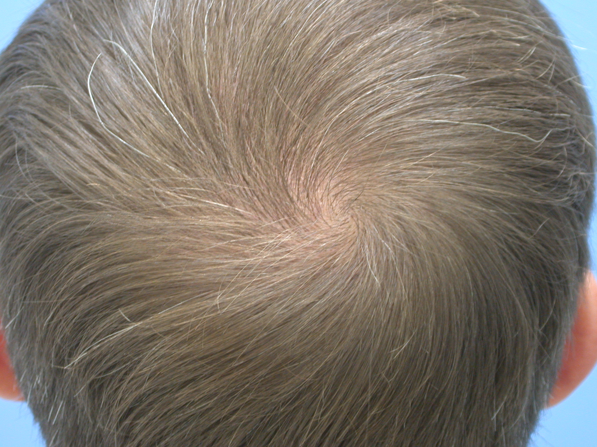 Hair transplant for the crown. Hair loss Forum Hair Transplant forums