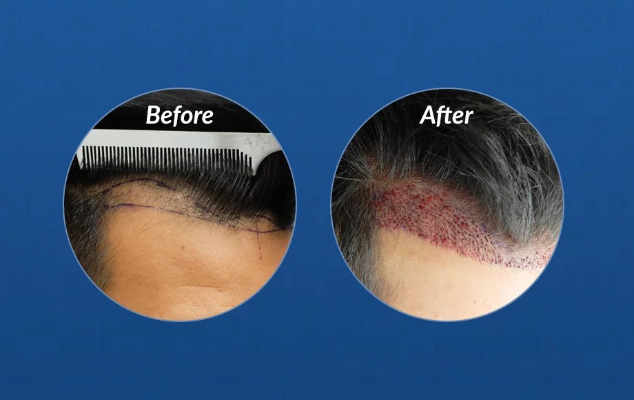 FUE Hair Transplant Timeline Hasson & Wong