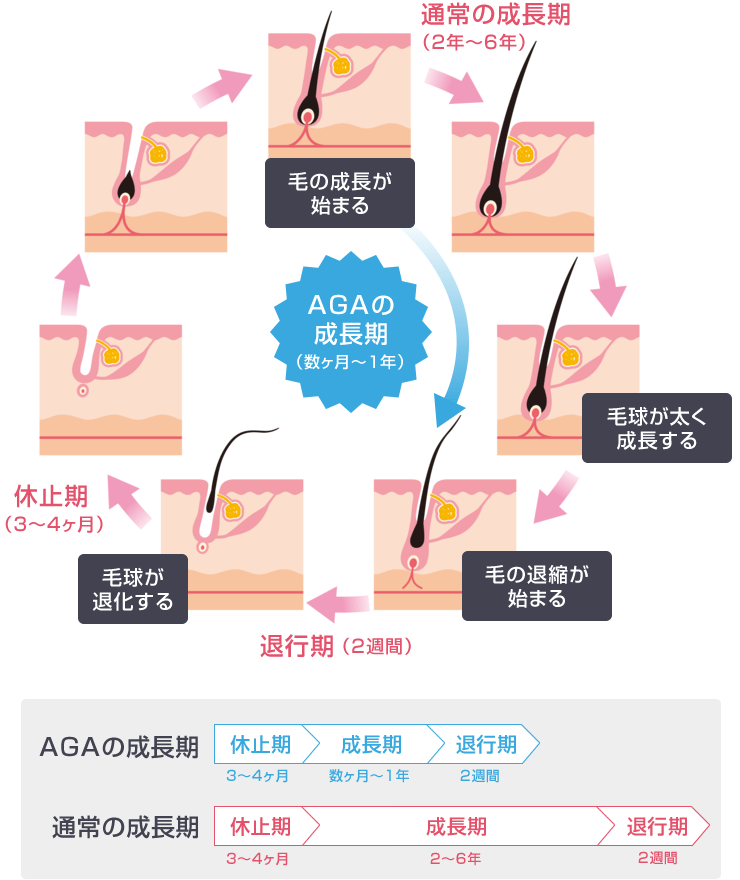 AGA(男性型脱毛症)の原因 髪育盛