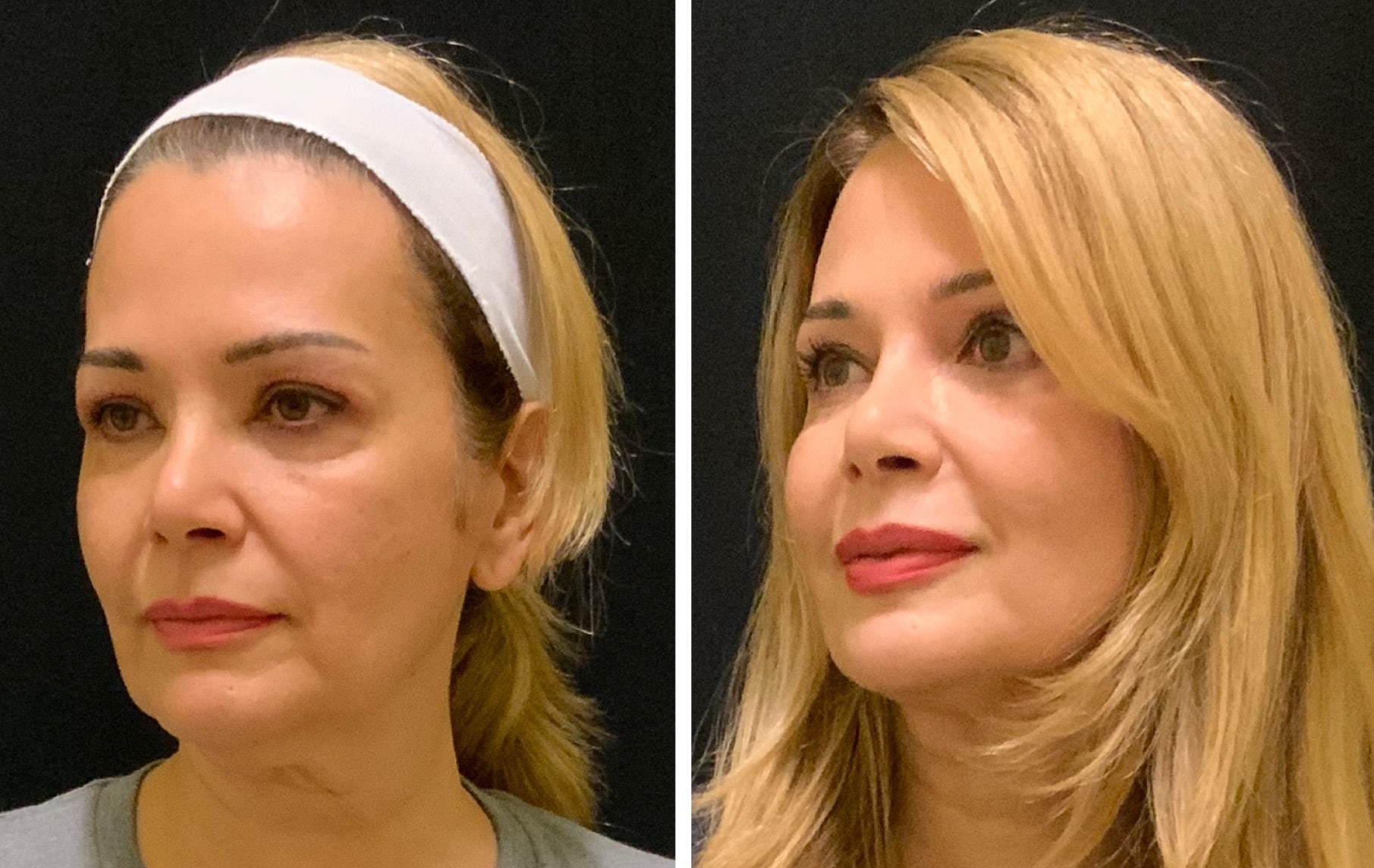 Facial Fat Transfer Newport Beach Hautspa Medica