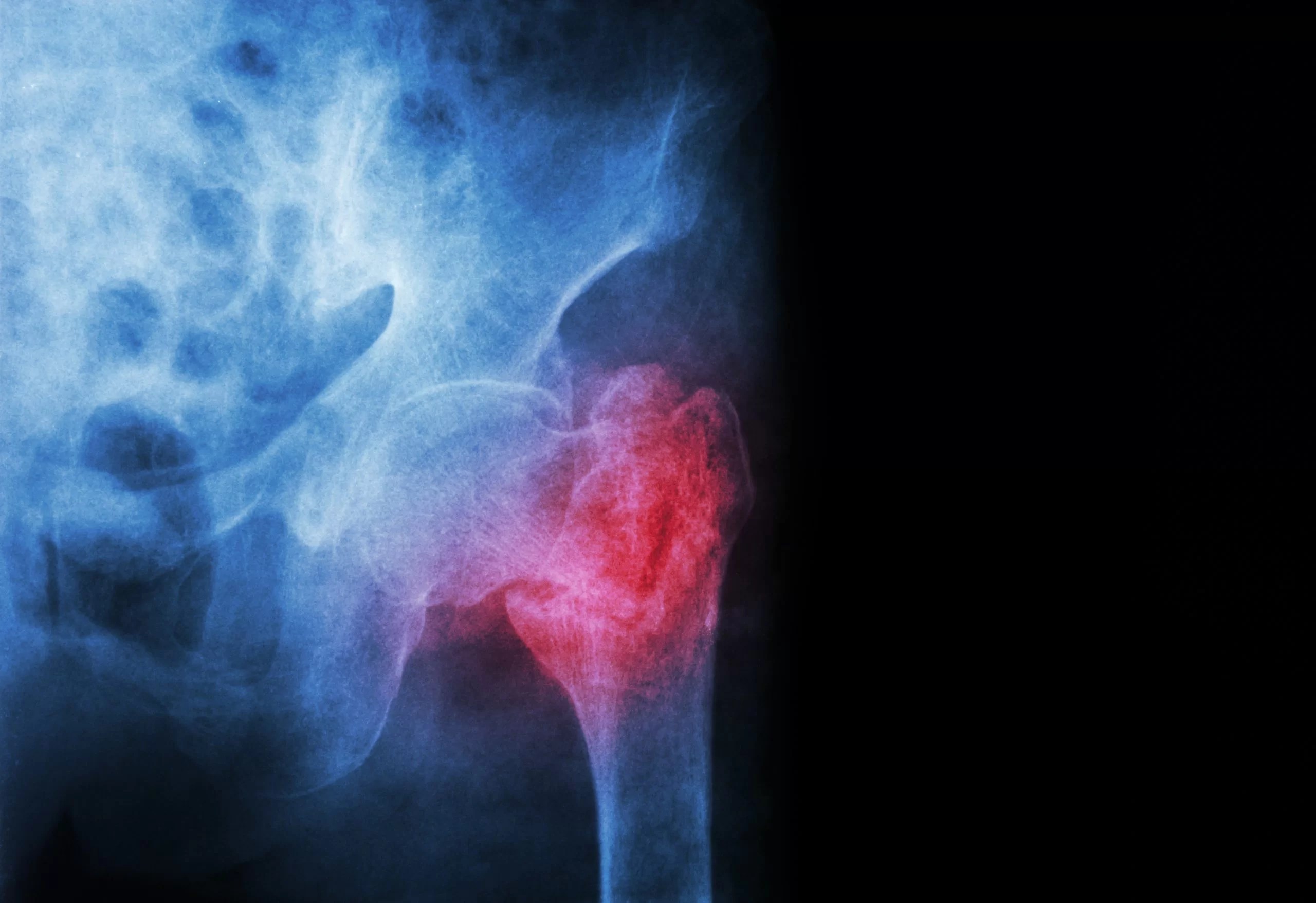 How Long Does a Bone Fracture Take to Heal? Hollywood Diagnostics