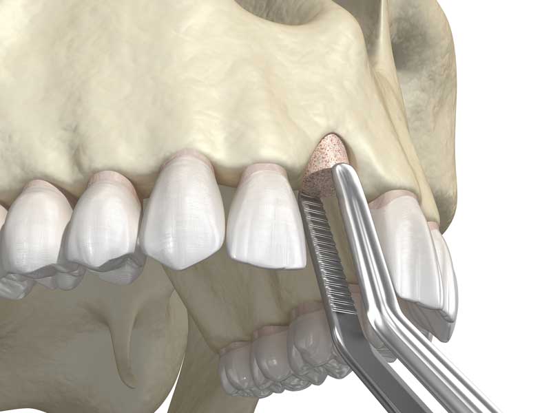 Bone Grafting for Facial Reconstruction » Head & Neck Surgical