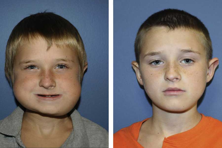 Treating Cleft Palate With Surgery » Head & Neck Surgical Associates