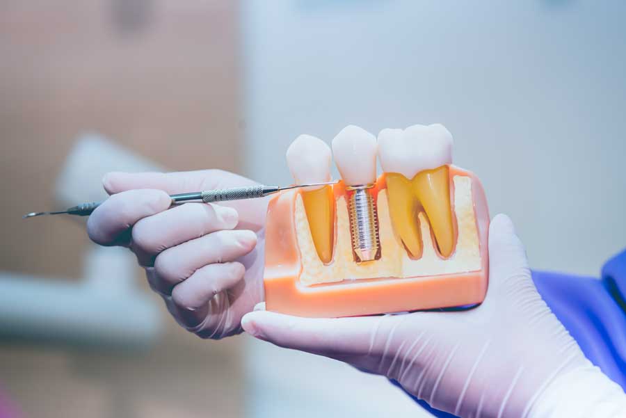 Are Dental Implants Ever Medically Necessary? » Head & Neck Surgical