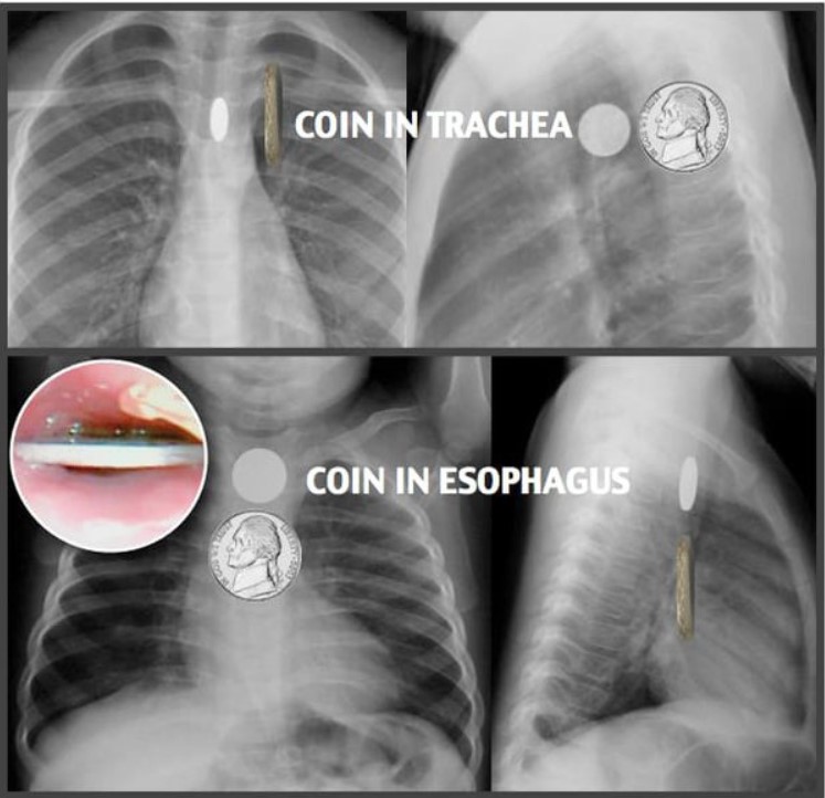 Can Swallowing a Coin Kill You? Healing Picks