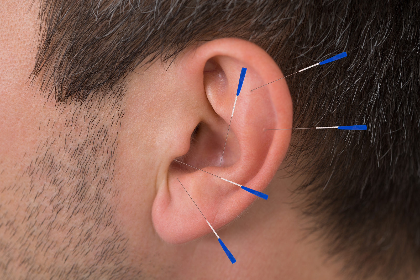 Auricular Acupuncture can help with Weightloss Healing with Zen