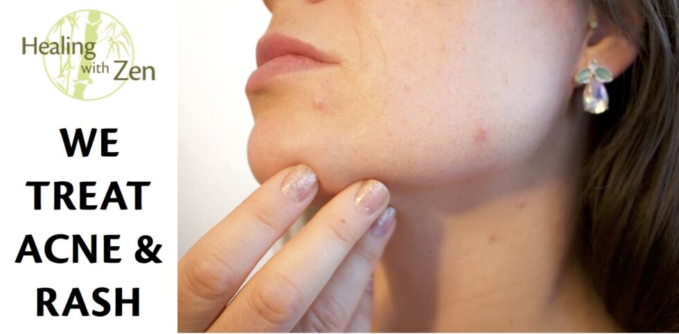 Acne in regards to Stress, Hormones, and Menstruation