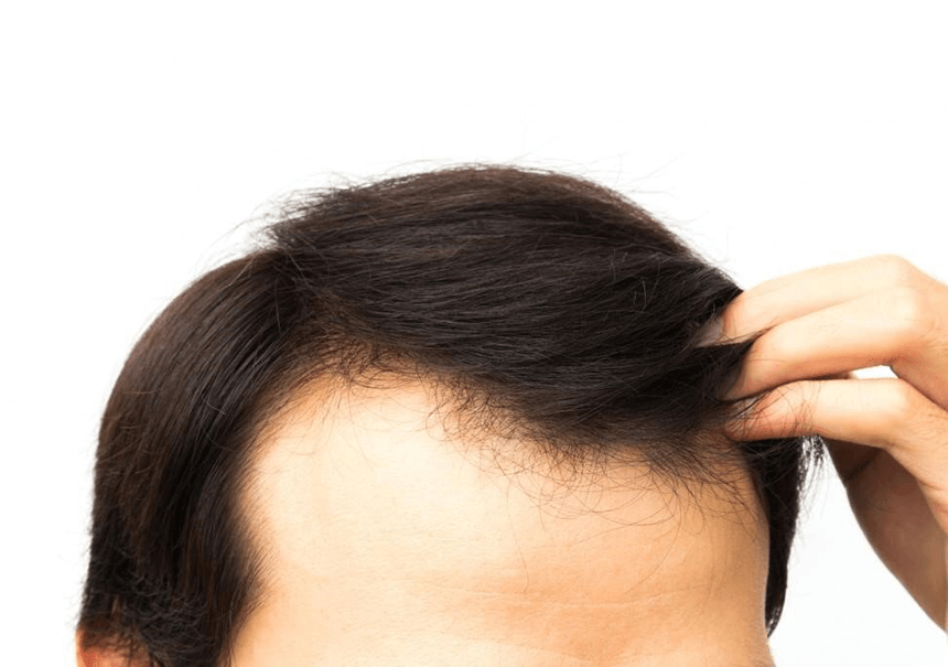 Prevent and Reverse Hair Loss in Men HEALOR