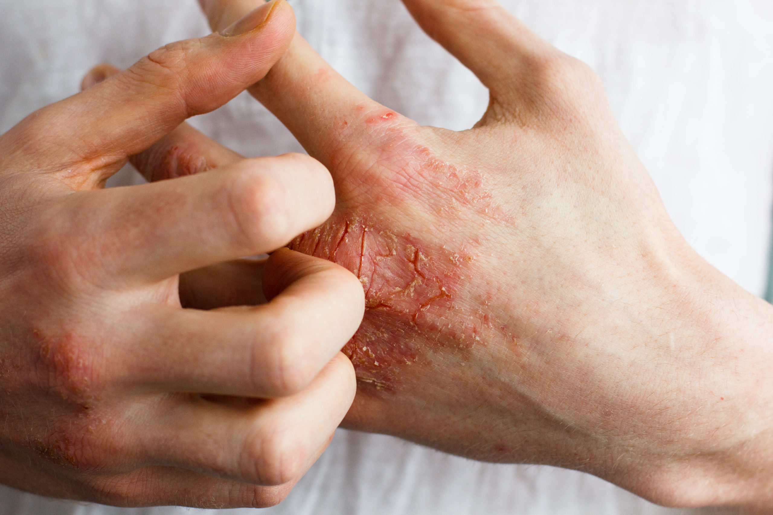 Everything You Need To Know About Managing Eczema SelfDecode Health