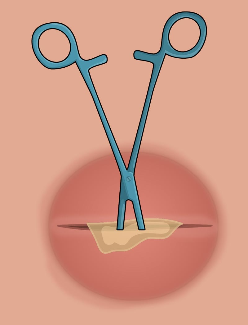 I&D How to perform an Incision & Drainage Health And Willness