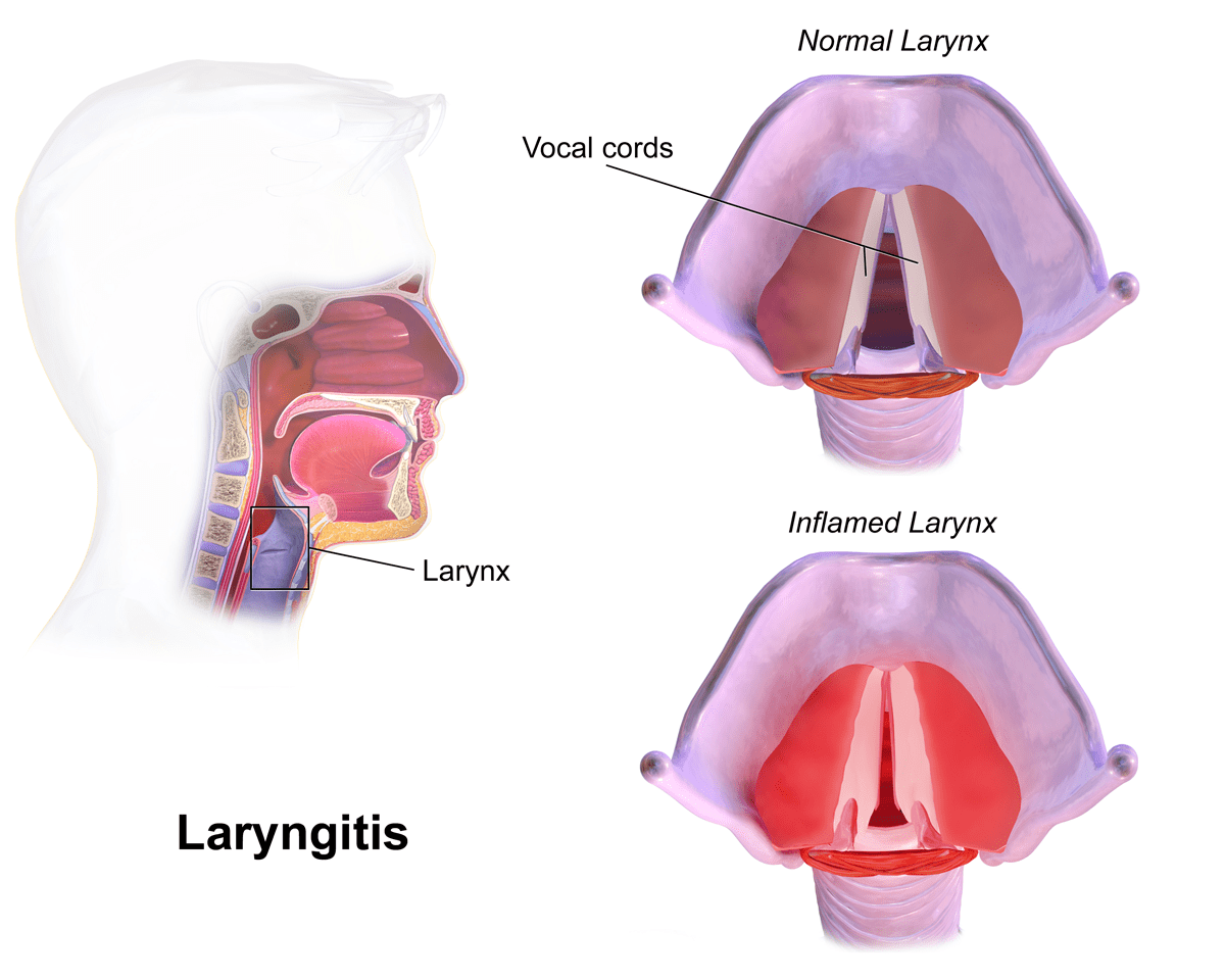 Best Ways on How to Treat Laryngitis Health Cautions