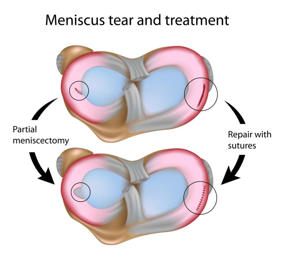 Medial Meniscus Tears What Is, Treatment, Prognosis, Causes
