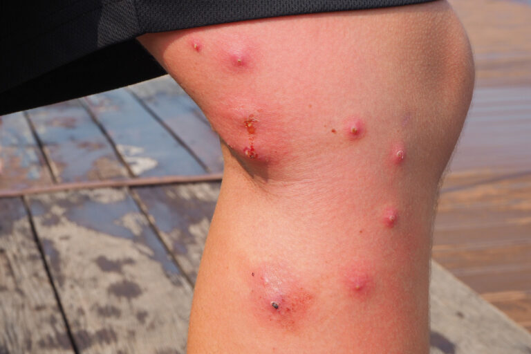 What does an infected mosquito bite look like? Healthera Order NHS Prescriptions & Medicines
