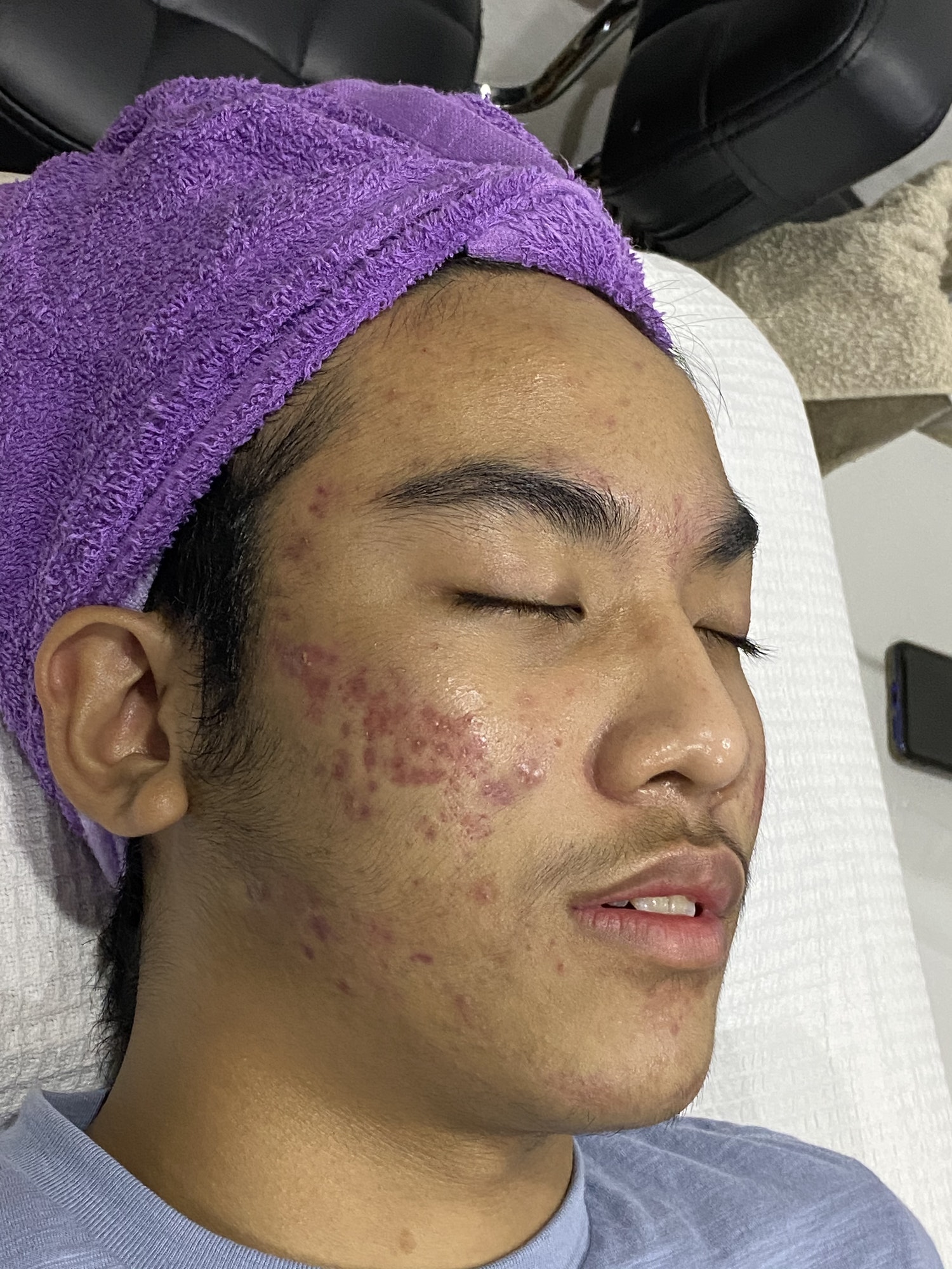 Decoding Ovulation 5 Best Tips for Understanding Acne and Management